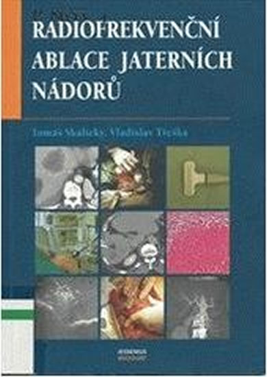 Obrázok Radiofrekvenční ablace jaterních nádorů