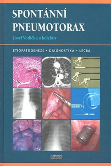 Obrázok Spontánní pneumotorax