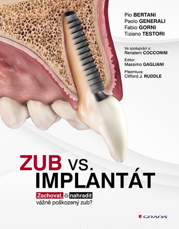 Obrázok Zub vs. implantát