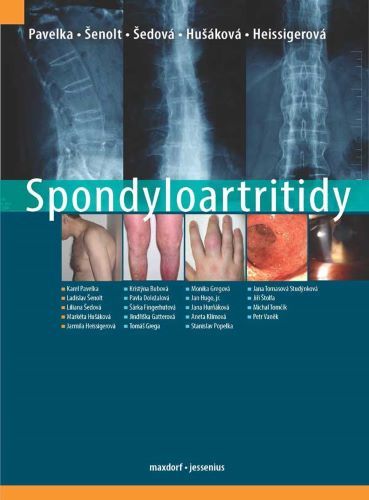 Obrázok Spondyloartritidy