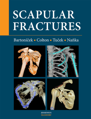 Obrázok Scapular fractures