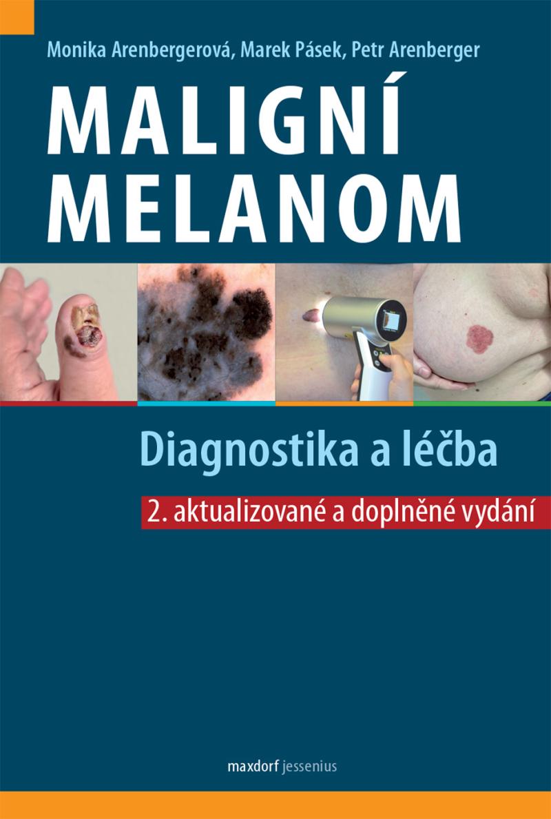 Obrázok Maligní melanom - Diagnostika a léčba