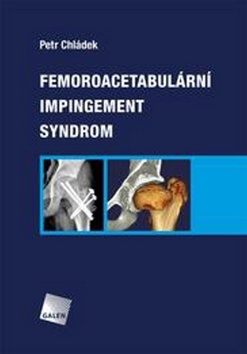 Obrázok Femoroacetabulární impingement syndrom