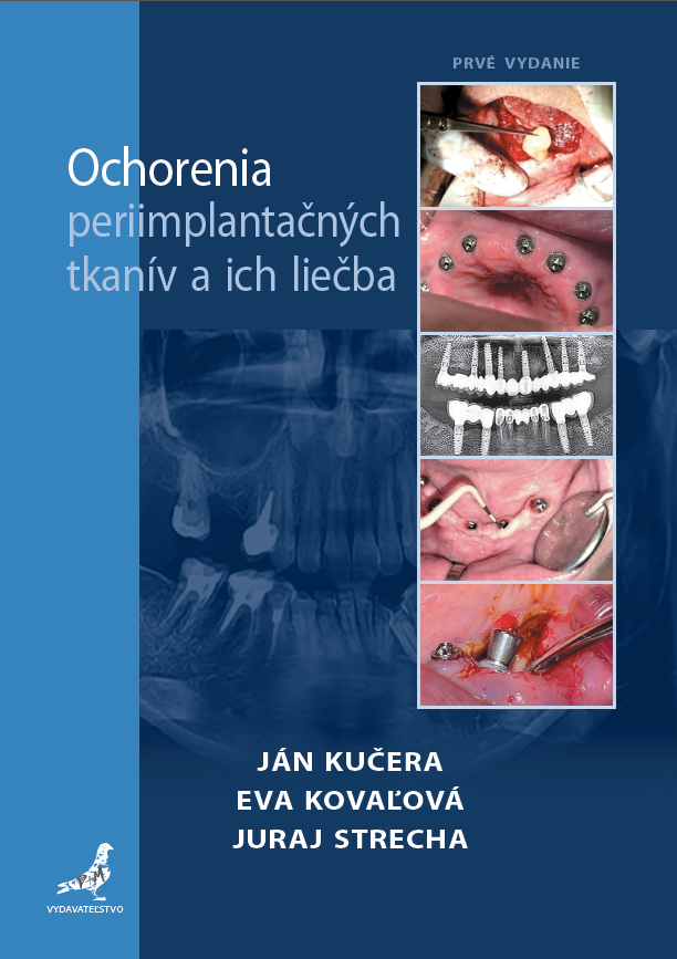 Obrazok Ochorenia periimplantačných tkanív a ich liečba
